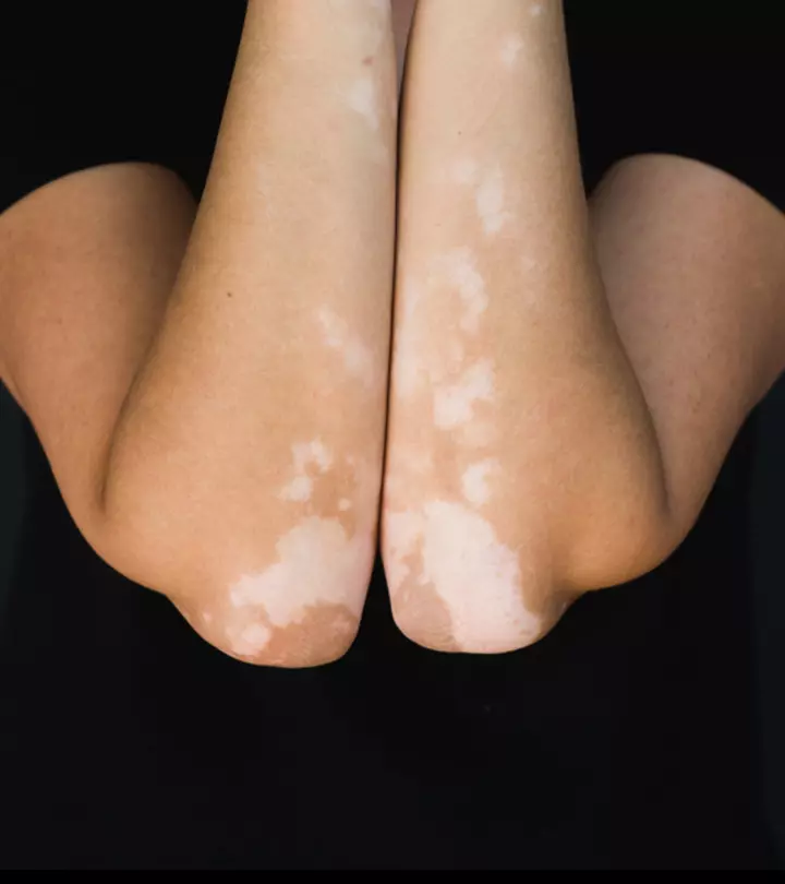 सफेद दाग के लिए डाइट चार्ट : Vitiligo (Leucoderma) Diet chart in Hindi_image