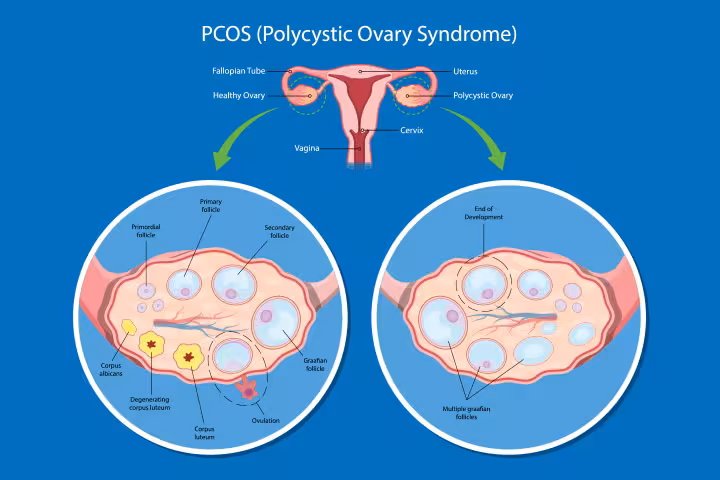 What is PCOS