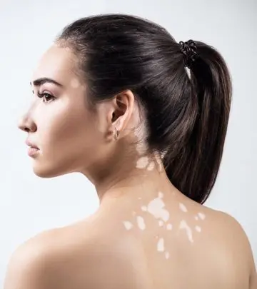 सफेद दाग के कारण और हटाने के घरेलू उपाय – White Spots (Vitiligo) Home Remedies in Hindi_image