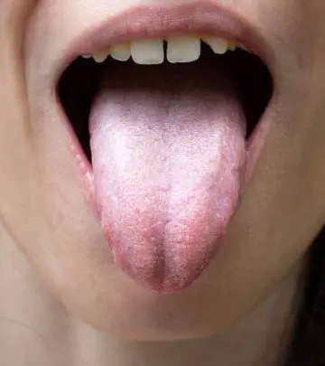 सफेद जीभ के कारण, लक्षण और घरेलू उपाय – White Tongue Causes, Symptoms and Home Remedies in Hindi_image