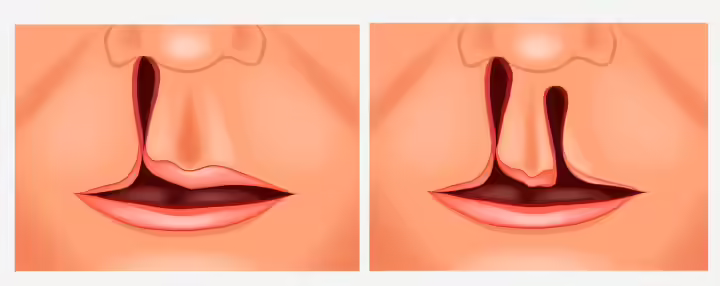 cleft palate in children1