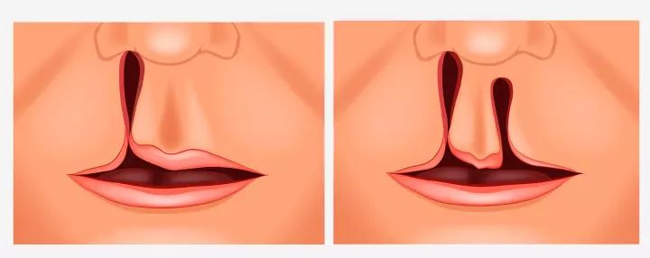 cleft palate in children1