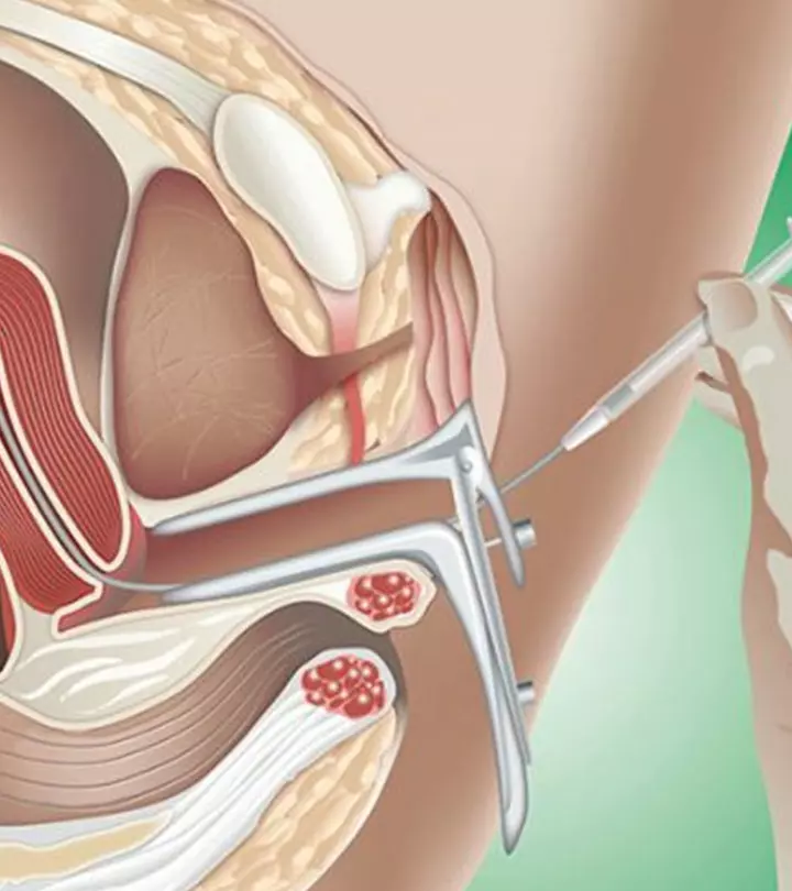 आईयूआई (IUI) कैसे होता है? प्रक्रिया, उपचार और सफलता के टिप्स_image