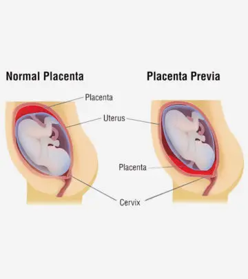 प्लेसेंटा प्रिविआ (अपरा नीचे स्थित होना) के उपचार, लक्षण और कारण | Placenta Previa In Hindi_image