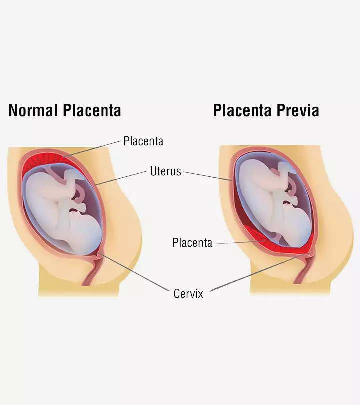 प्लेसेंटा प्रिविआ (अपरा नीचे स्थित होना) के उपचार, लक्षण और कारण | Placenta Previa In Hindi_image