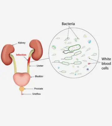 गर्भावस्था में यूरिन इन्फेक्शन (यूटीआई) – कारण, लक्षण और इलाज_image