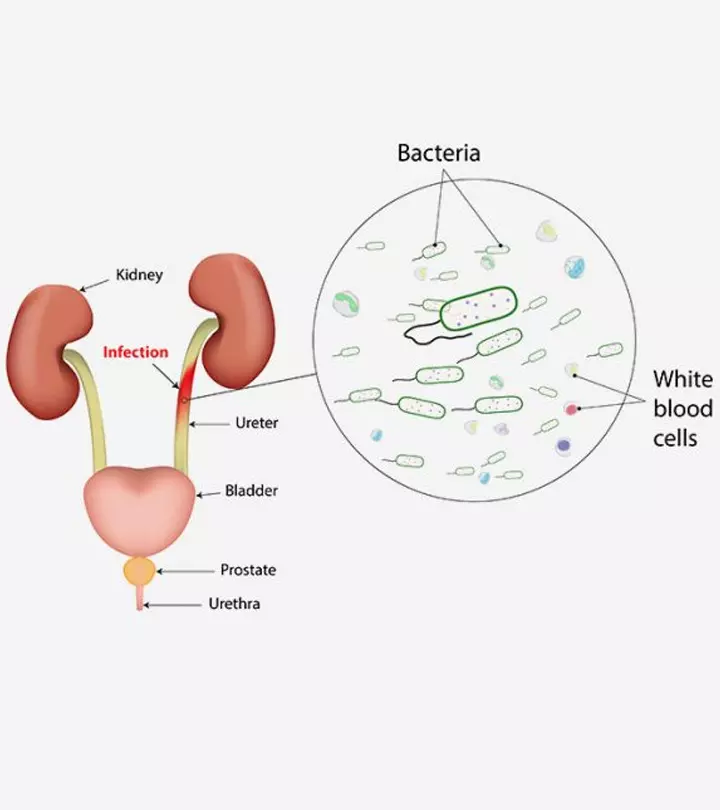 गर्भावस्था में यूरिन इन्फेक्शन (यूटीआई) – कारण, लक्षण और इलाज_image