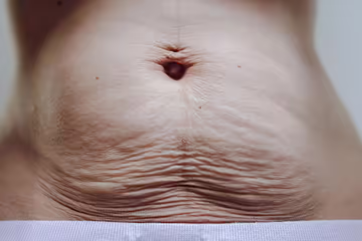 Linea Nigra fades into a lighter shade after childbirth