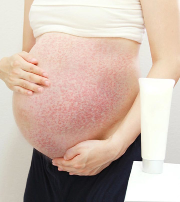 PUPPP Rash: Causes, Symptoms And Treatment_image