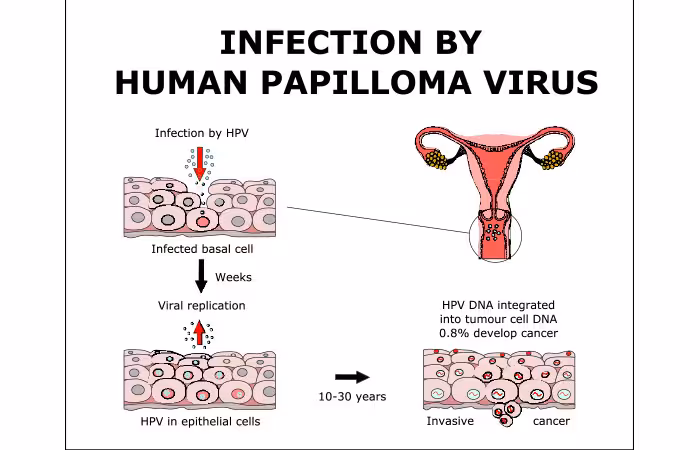 Illustration of genital warts