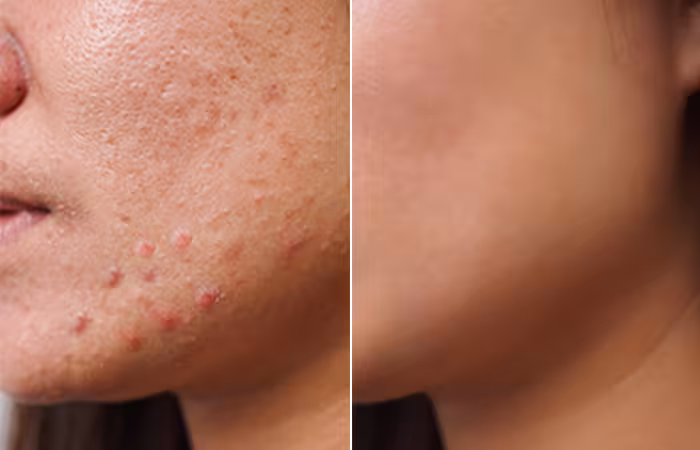 Before And After Using Blue Light