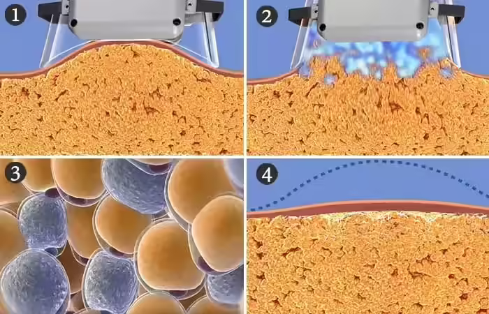 What Does A Fat Freezing Machine Do