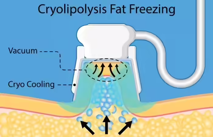 What Is A Fat Freezing (CoolSculpting) Machine