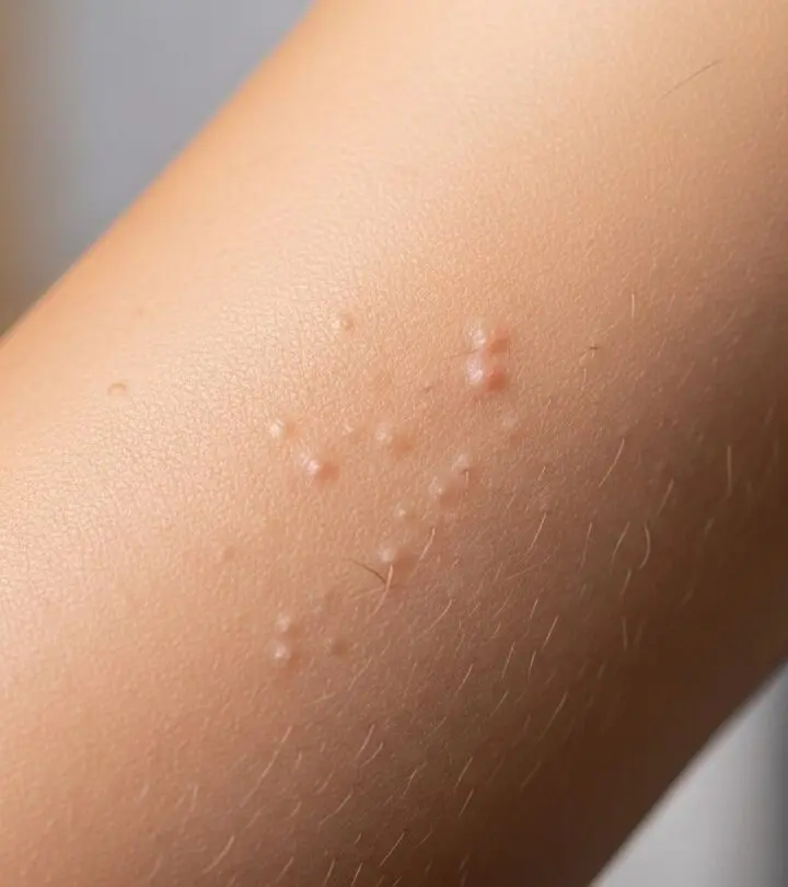 Effective Treatments for Keratosis Pilaris Simplify your approach to managing keratosis pilaris with these effective treatments.