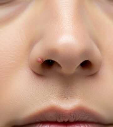 Effective Home Remedies for Pimples Inside the Nose: Causes, Treatments, and Prevention