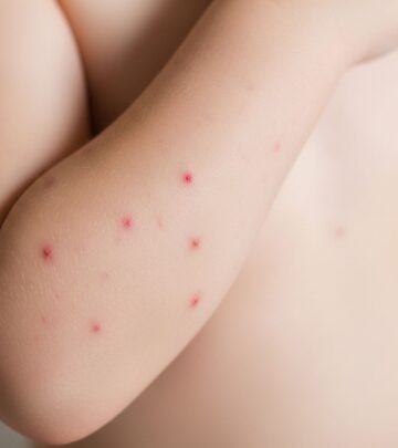 16 Proven Home Remedies for Chickenpox: Relief & Recovery