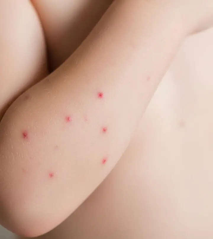 16 Proven Home Remedies for Chickenpox: Relief & Recovery Discover safe, effective home remedies to soothe chickenpox symptoms, promote healing, and prevent discomfort for all ages.