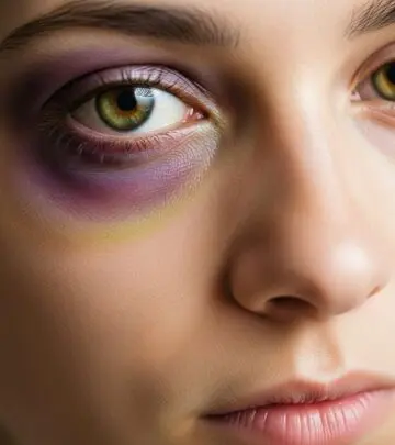 Discover effective home remedies, essential tips, and preventive strategies to heal and conceal a black eye quickly and safely.