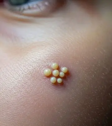 A Complete Guide to Understanding, Treating, and Preventing Milia for Clearer, Healthier Skin