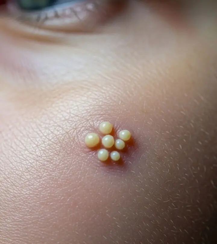 How To Get Rid Of Milia: Causes, Treatments, and Prevention Tips A Complete Guide to Understanding, Treating, and Preventing Milia for Clearer, Healthier Skin