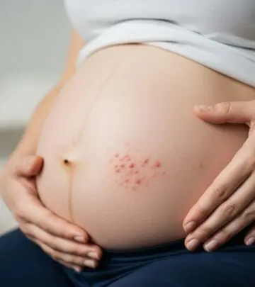 PUPPP Rash in Pregnancy: Symptoms, Causes & Effective Natural Treatments Comprehensive Guide to Understanding, Managing, and Naturally Treating PUPPP Rash During Pregnancy.