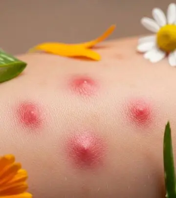 Discover effective natural remedies and expert tips to fade red spots and achieve clearer, healthier skin.