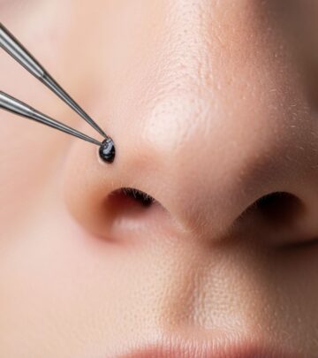 How To Remove Deep Blackheads Safely And Effectively