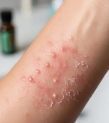 Explore side effects of tea tree oil, including skin reactions, toxicity, hormonal impacts, and safety tips for healthy use.