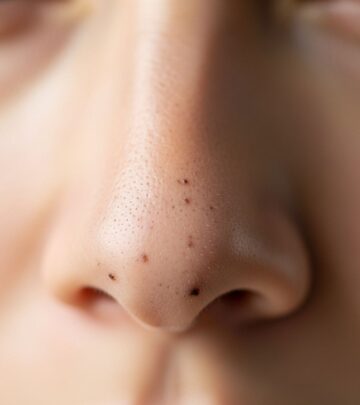 13 Proven Ways to Remove Blackheads from the Nose and Prevent Them