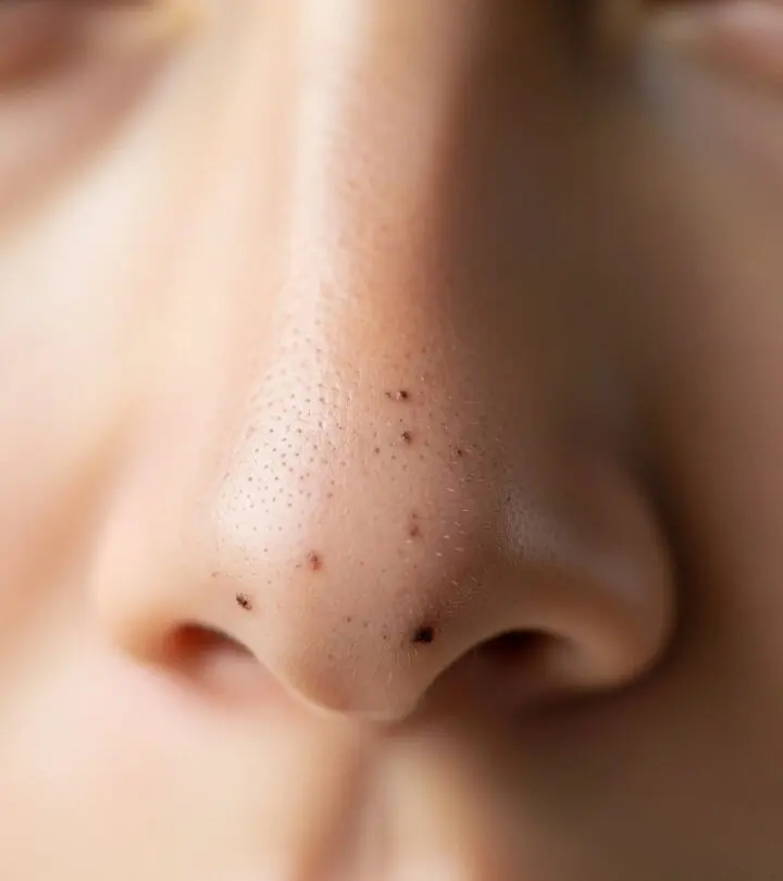 Explore expert-backed treatments, home remedies, and lifestyle habits to effectively remove and prevent blackheads on your nose.