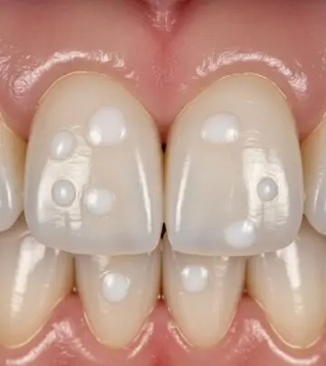 White Spots on Teeth: Causes, Treatments & Prevention Discover why white spots appear on teeth and effective solutions to restore your smile's natural brightness